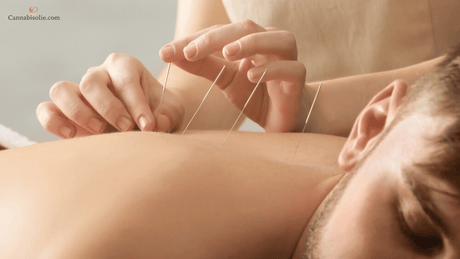 CBD olie en Acupunctuur: natuurlijke combinatie voor balans